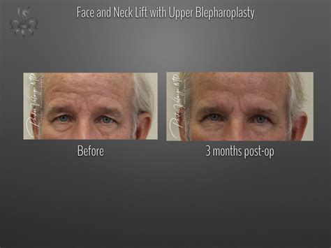 Blepharoplasty Eyelid Surgery Case 4327 New Orleans Premier Center