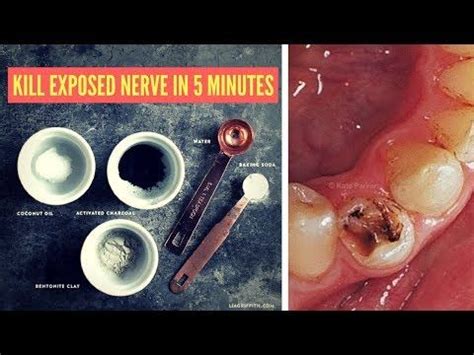 By the time you've finished treatment, we've know precisely where your teeth are and the exact shape of your retainer. How To Kill A Tooth Nerve Without Root Canal