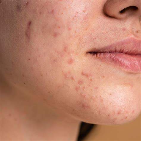 Acne Holes On Face Types Treatment Cost And Prevention Tips Uncover