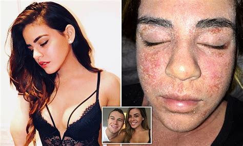 Eczema Sufferer 24 Fell Into A Deep Depression After Ditching Steroid