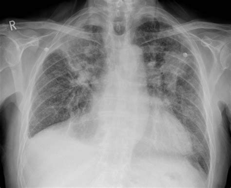 Progressive Massive Fibrosis Radiology Case Human