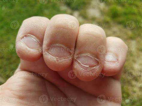 Bitten Nasty Unhealthy Gross Chewed Fingernails Bad Habit Stock Photo At Vecteezy