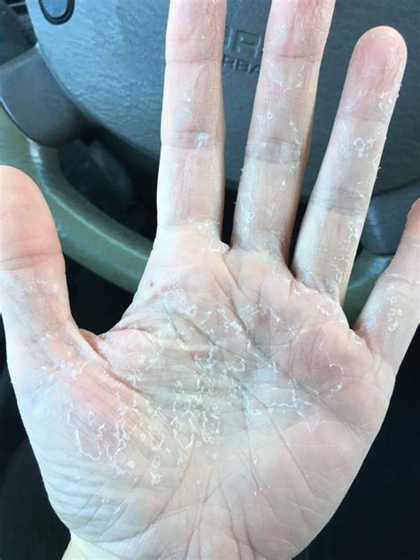 My Hands After An Allergic Reaction To Antibiotics That Caused Hives