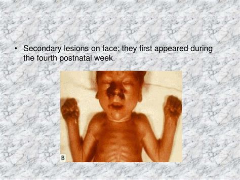 Ppt Congenital Syphilis Powerpoint Presentation Free Download Id