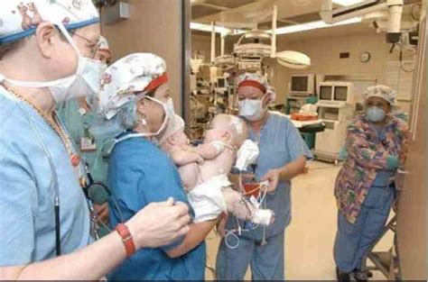 Rare Triplets With Two Conjoined Given Up For Adoption 16 Years Ago