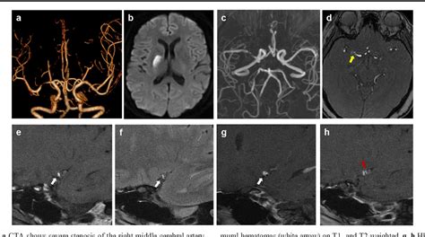 A Case Of Middle Cerebral Artery Dissection Presenting With Capsular