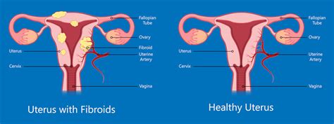Uterus Cancer Signs