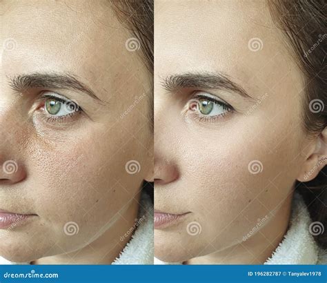 Woman Face Sagging Puffy Wrinkles Beautician Therapy Regeneration
