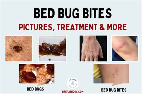 Bed Bug Bites Pictures Symptoms Treatment And Prevention