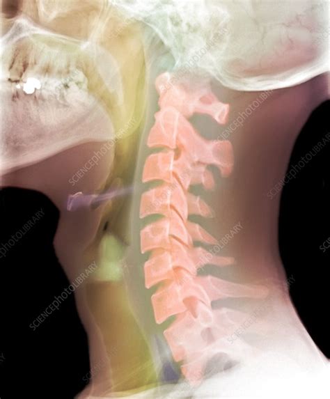 Normal Neck X Ray Stock Image C0106067 Science Photo Library