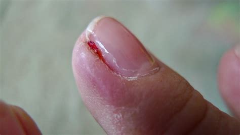How Do You Treat A Cuticle Inflammation Or Paronychium