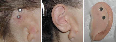 Prosthetic Ear Over Microtia A Treatment Option Life Like Prosthetics