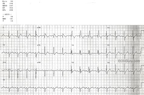 Right Bundle Branch Block With Left Anterior Fascicular Block Ecg