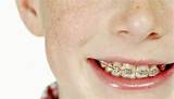 Payment Plan For Braces Without Insurance
