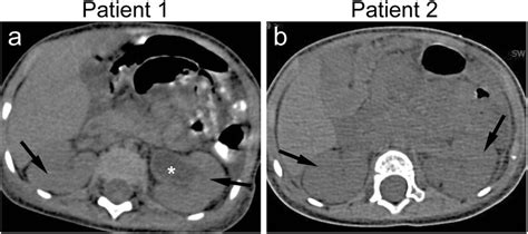 Axial Abdomen Ct Scan Images Of Patients 1 And 2 A B Showing