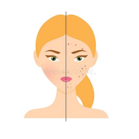Woman With Acne Skin Problem And Healthy Skin Vector Illustration