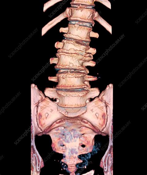 Spinal Compression Fracture 3d Ct Scan Stock Image C0299967