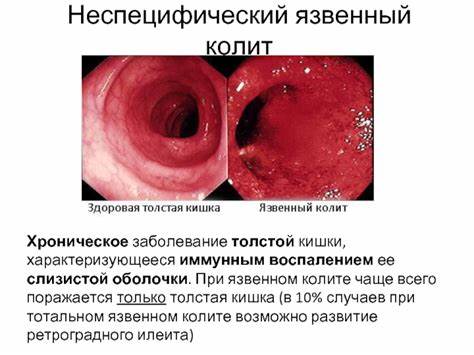 Диета при неспецифический язвенный колите Хирургическое лечение неспецифического язвенного колита и болезни Крона Хирургическое лечение неспецифического язвенного колита и болезни Крона Диета при неспецифический язвенный колите