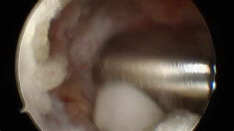 Première chirurgie endoscopique de UBE Plasma Chirurgie du dos