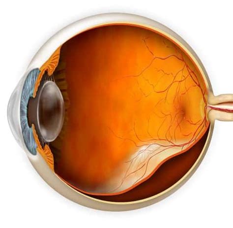 Retinal Detachment Dambrosio Eye Care Detached Retina