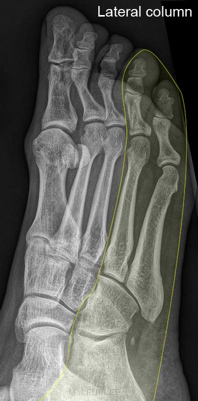 Nutcracker Fracture Of The Cuboid Wikiradiography