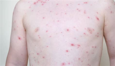 Chickenpox Outbreak Hits Warrnambool School The Standard