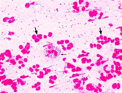 Neisseria Gonorrhoeae Present In A Gram Stain Of A Patient With Gonococcal Urethritis The N
