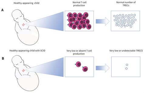 Newborn Screening For Severe Combined Immunodeficiency A Primer For