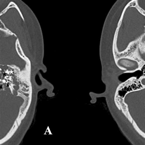 Patient 8 Axial Ct Scan Through Cochlear Aqueduct Shows Bilateral