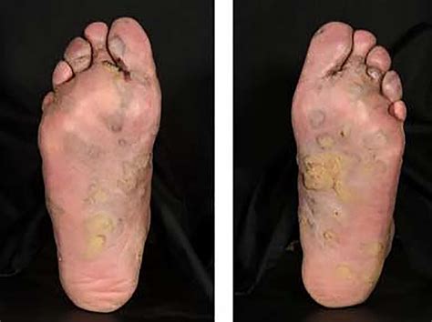 An Unusual Rash On The Feet The Bmj