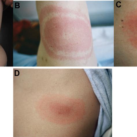 Typical Expanding Skin Lesions Notes Erythema Migrans Are Essential