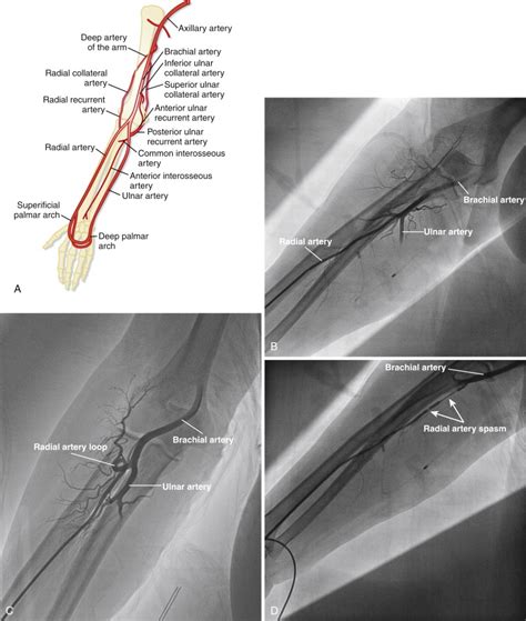 Coronary Angiography Technique Radiology Key