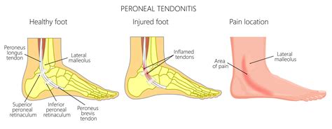 Muscles tendons and ligaments run along the surfaces of the feet allowing the complex movements needed for motion and balance. Tendon problems in the ankle joint | Buxton Osteopathy Clinic
