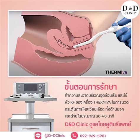 Vaginal Rejuvenation By Thermiva D D Clinic