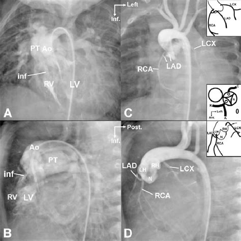 Angiogram In Lv A And B And Aorta C And D In Patient 7 Ca Type