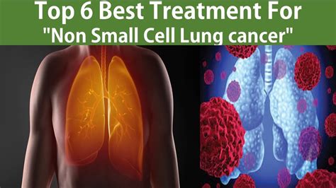 Top 6 Best Non Small Cell Lung Cancer Treatment 😱 Treatments Are