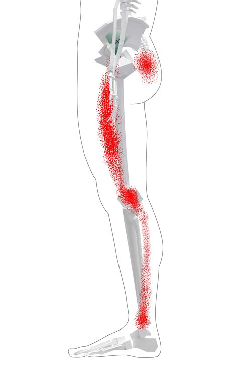 Gluteus Minimus Trigger Points Overview Self Treatment Tips