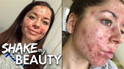 Doctors Told Me I Had The Worst Acne Theyd Ever Seen SHAKE MY BEAUTY YouTube