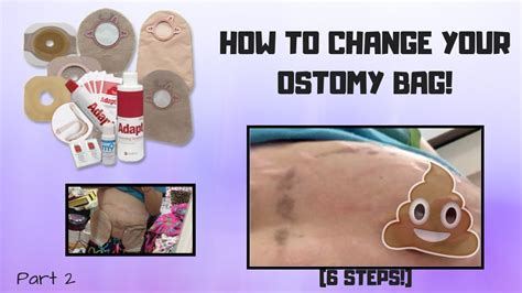 Changing Colostomy Bag