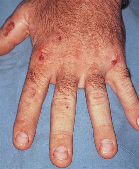 Bullous Eruption In A 36 Year Old Man With Polycystic Kidney Disease