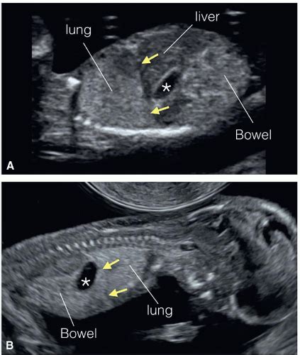 The Fetal Gastrointestinal System Radiology Key