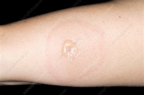 Insect Bite Allergy Stock Image C0016620 Science Photo Library