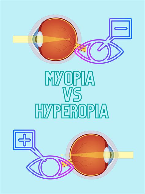 Myopia Vs Hyperopia