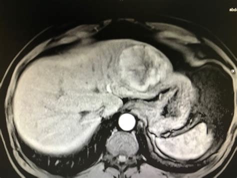 Vietnamese Medic Ultrasound Case 474 Left Liver Lobe Tumor Dr Phan