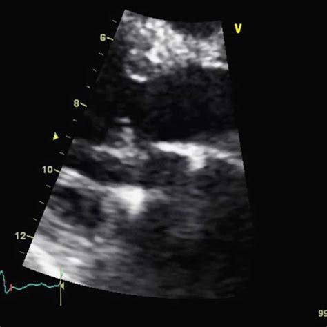 Transthoracic Echocardiogram With Continuous Wave Doppler Study Of The