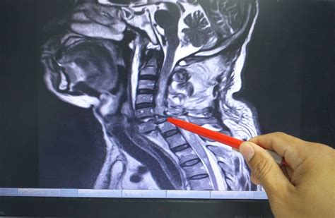 Cervical Spine Curve And Injuries