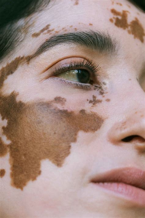 Photographer Develops Vitiligo Creates A Series Featuring Other Women