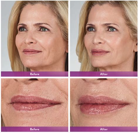 Juvederm Volbella Newport Beach Adds Volume To Lips And Minimizes
