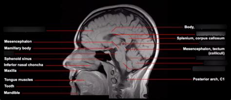 MRI Of Sagittal Brain Diagram Quizlet