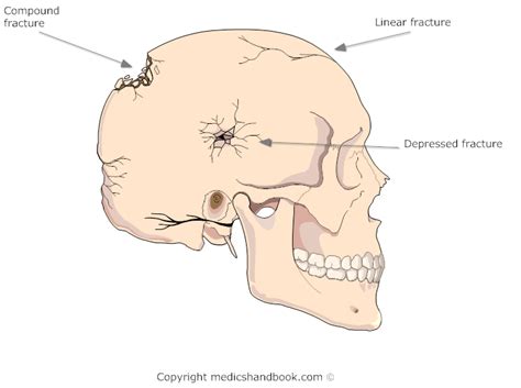 Types Of Skull Fracture Fracture Treatment
